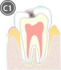 虫歯C1