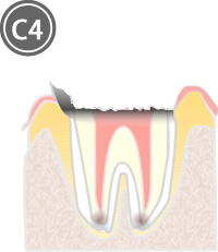 虫歯C4