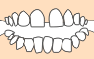 すきっ歯