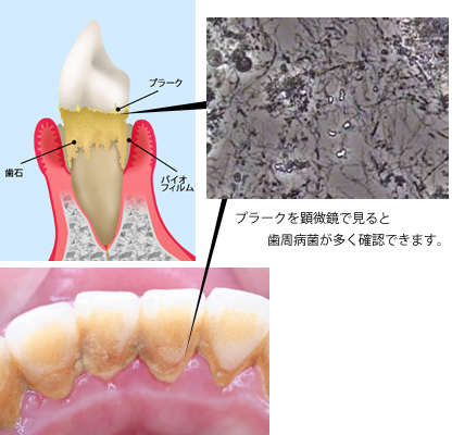 歯周病と口臭